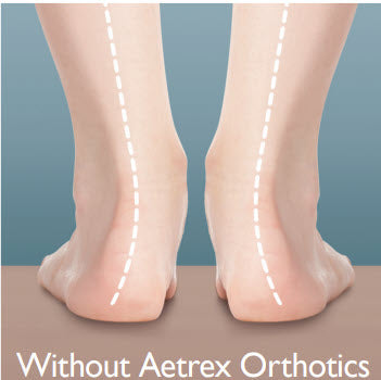 How to Choose Insoles for Flat Feet
